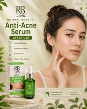 RB Anti-Acne Serum 30ml